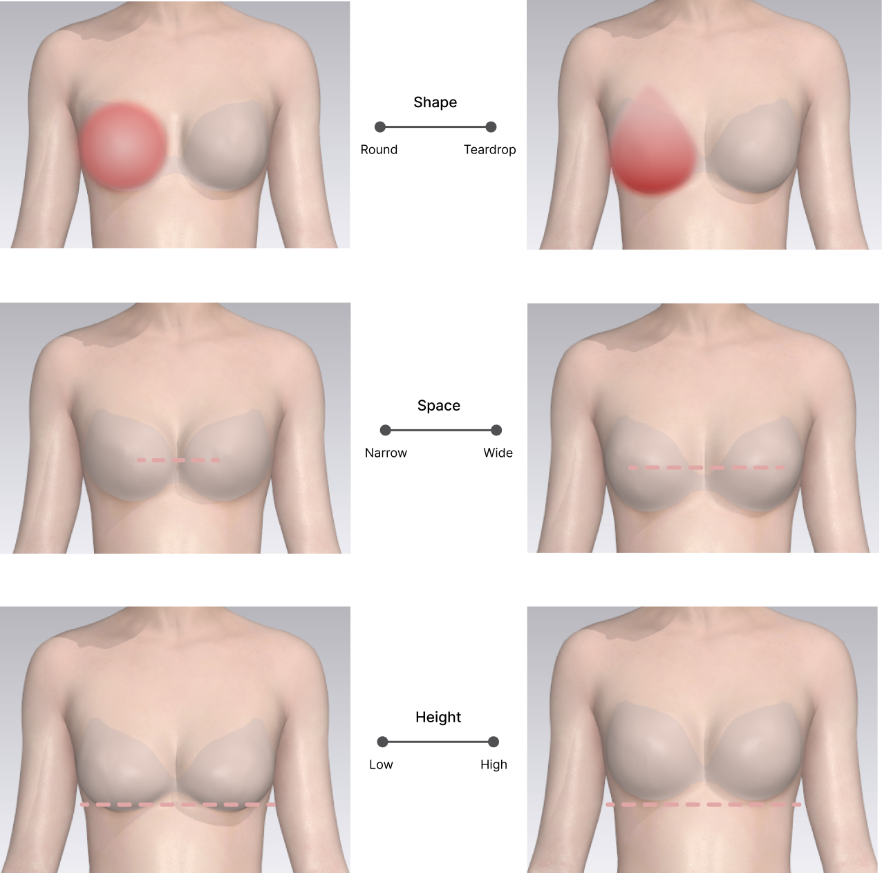 Breast.png